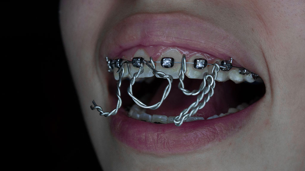 the word joy hanging in my braces with wire